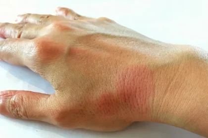 anvisa-aprova-novo-medicamento-para-tratar-lupus