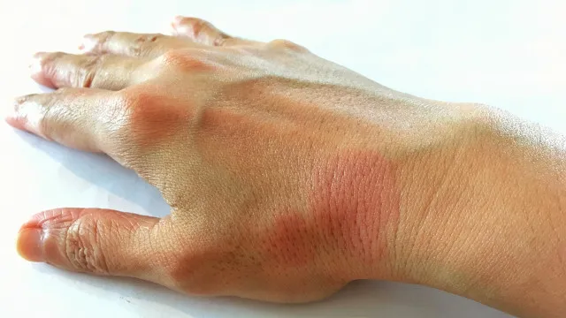 anvisa-aprova-novo-medicamento-para-tratar-lupus
