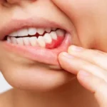 retracao-gengival:-por-que-a-gengiva-se-afasta-dos-dentes-e-como-prevenir