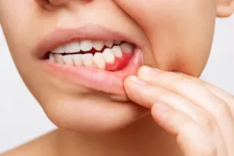retracao-gengival:-por-que-a-gengiva-se-afasta-dos-dentes-e-como-prevenir