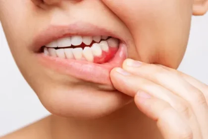 retracao-gengival:-por-que-a-gengiva-se-afasta-dos-dentes-e-como-prevenir