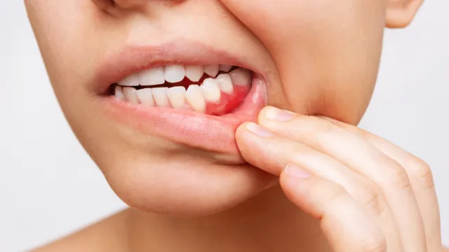 retracao-gengival:-por-que-a-gengiva-se-afasta-dos-dentes-e-como-prevenir